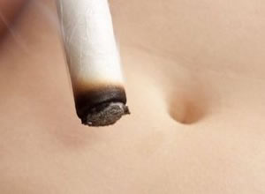 Moxibustion